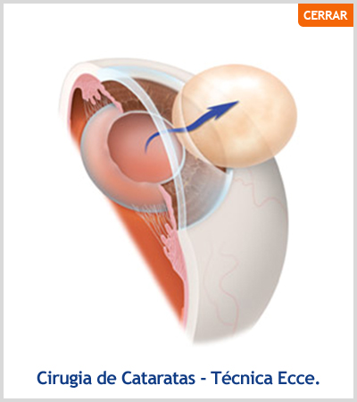 Cirugia de Cataratas. Técnica Ecce.