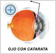 Glaucoma