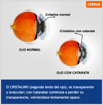 Ojo con Cataratas